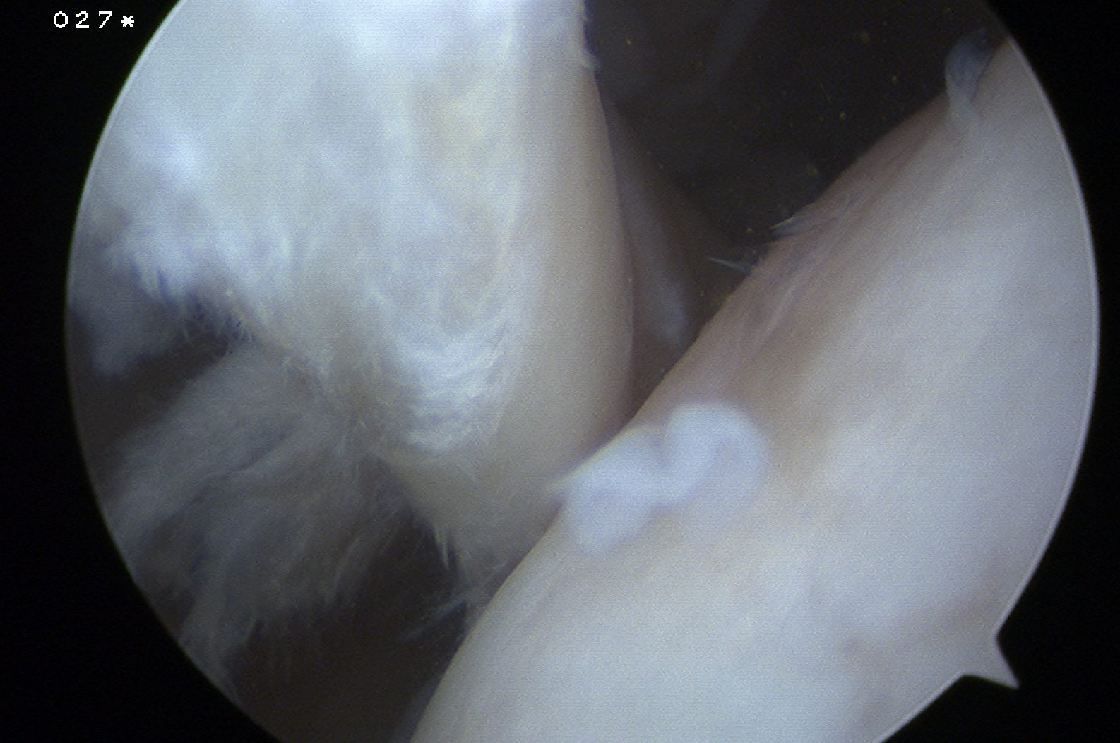 Shoulder Scope Dislocated Biceps Tendon